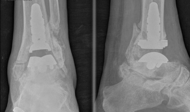 Ortopedistas do Instituto Ferrer são pioneiros no DF na realização da artroplastia de tornozelo